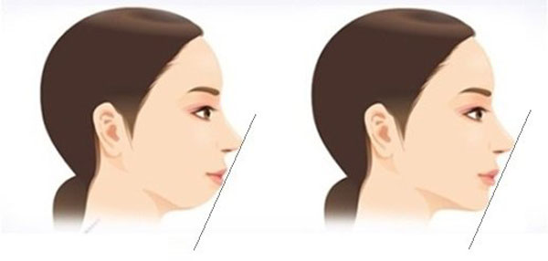 Dịch vụ tiêm filler cằm lẹm cằm ngắn tại Hải Phòng