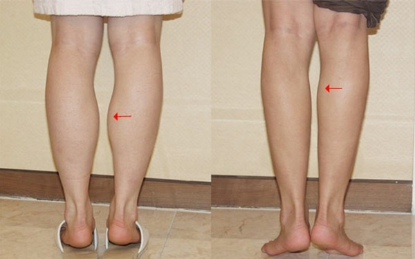 Những điều cần biết về tiêm botox thon gọn bắp chân