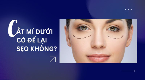 Cắt mí mắt dưới liệu có để lại sẹo