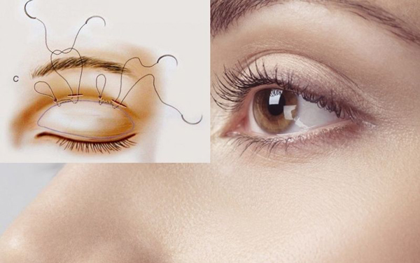 Có được bôi thuốc mỡ sau khi cắt chỉ mí mắt hay không