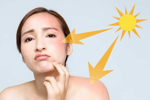 Nguyên nhân nám da do nắng