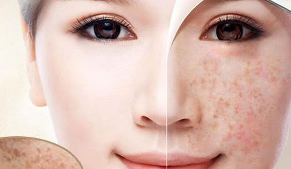 Trị nám da mùa nào hiệu quả