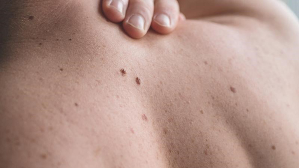 Cách phân biệt tàn nhang với nốt ruồi