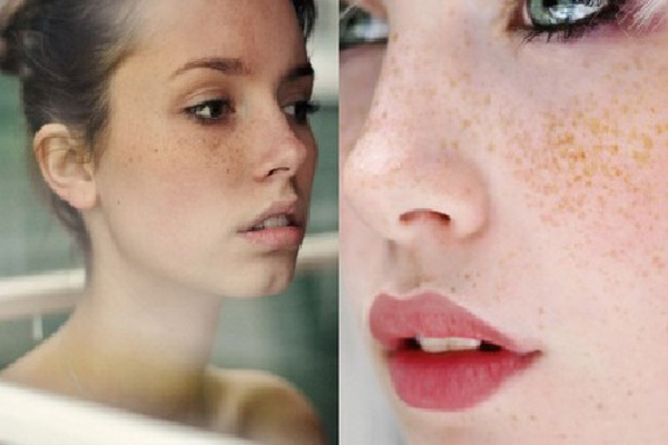 Lý do gây nám da tàn nhang ở tuổi dậy thì