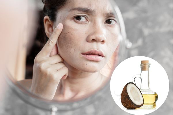 Phương pháp trị nám bằng dầu dừa