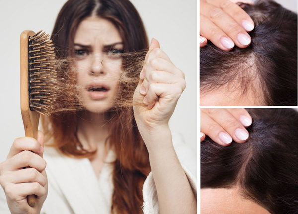 Điều trị rụng tóc tại Hải Phòng