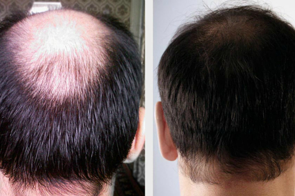Trị hói đầu tại Hải Phòng