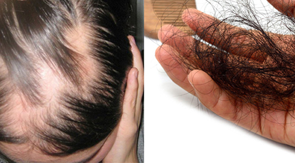 Trị rụng tóc tại Hải Phòng