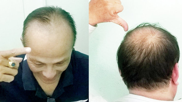 Cách điều trị hói đầu ở nam giới