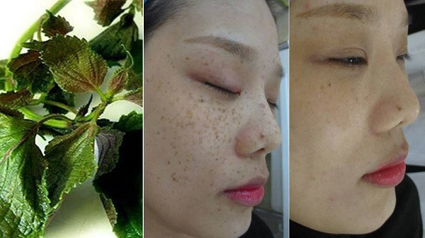 Cách trị tàn nhang bằng lá tía tô