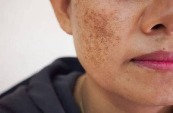 Cách trị nám chân đinh hiệu quả