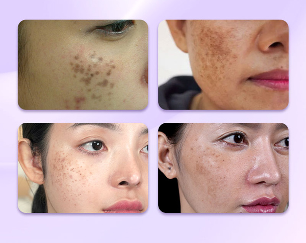 Nguyên nhân và cách trị nám chân đinh