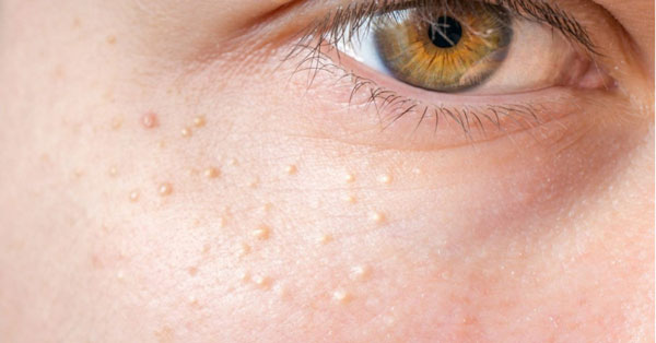 Điều trị mụn thịt tại Hải Phòng