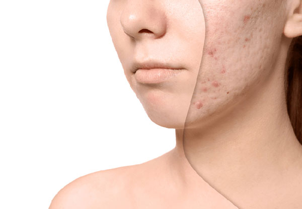 Một số cách chữa sẹo mụn đơn giản tại nhà