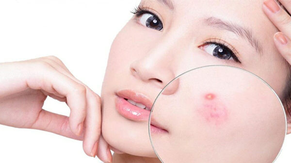 Cách chữa sẹo mụn đơn giản tại nhà