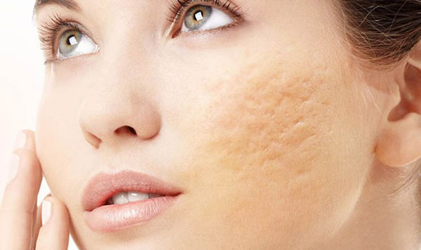 Sẹo rỗ sẹo lõm lâu năm có điều trị được không