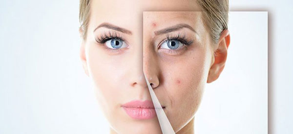 Sẹo rỗ, sẹo lõm lâu năm có điều trị được không?