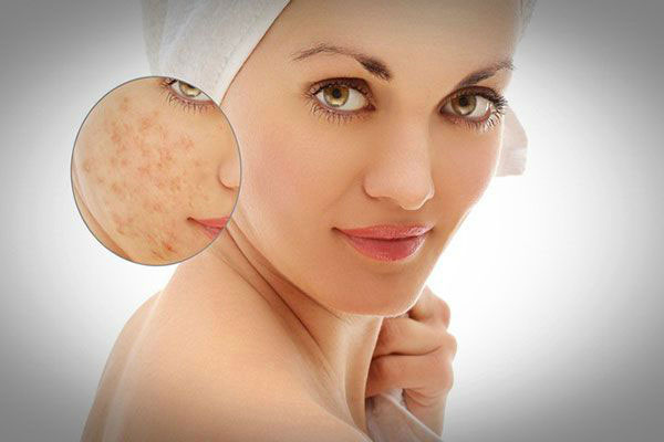 Sẹo rỗ sẹo lõm lâu năm có trị dứt điểm được không