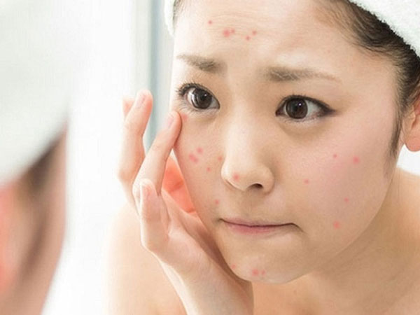 Chăm sóc da mụn vào mùa hè hiệu quả