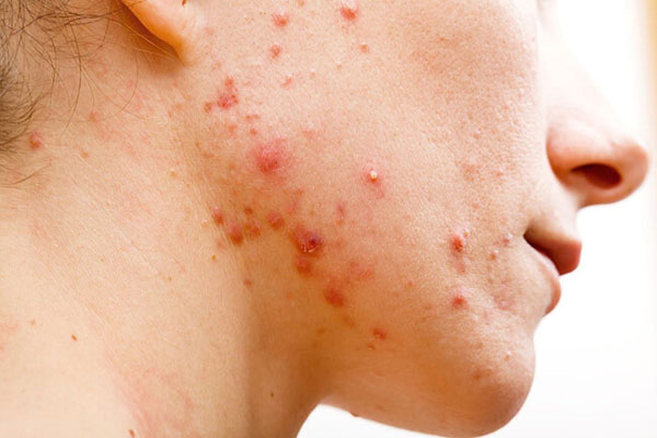 Lưu ý quan trọng khi nặn mụn mủ