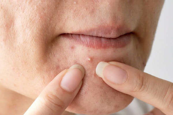 Mụn mủ có nên nặn không