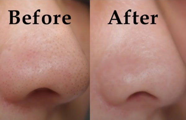 Bí quyết trị mụn đầu đen hiệu quả