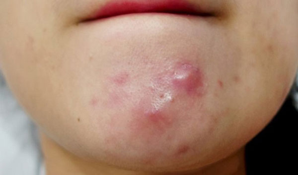 Mụn bọc và nguyên nhân hình thành mụn bọc