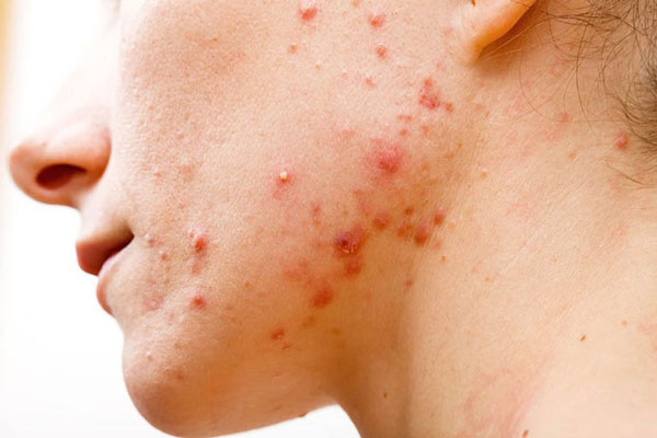 Tại soa mụn bọc lại khó chữa