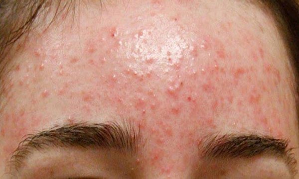 làm cách nào hết mụn ở trán