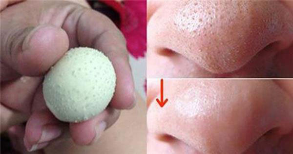 cách trị mụn cám đơn giản tại nhà