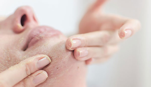 Tẩy tế bào chết khi da mụn có nên không