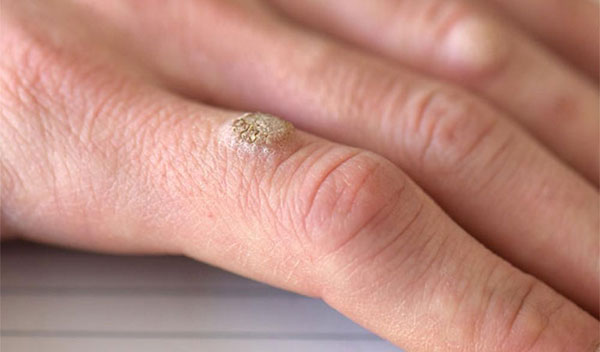 7 loại mụn cóc bạn nên biết