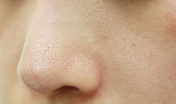 Các loại mụn thường mọc xung quanh mũi