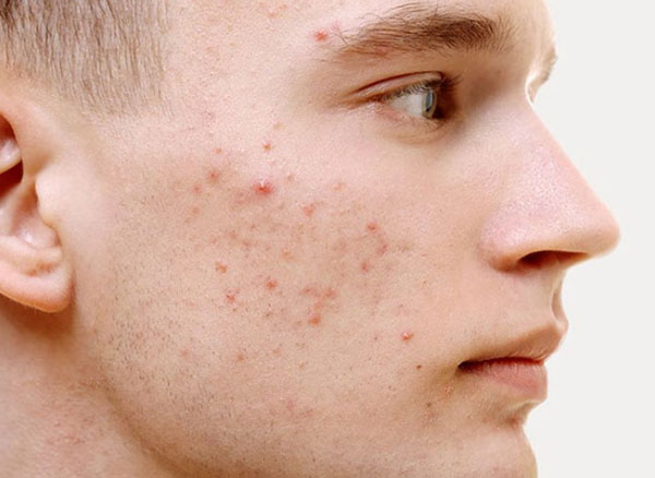 Các loại mụn trứng cá thường gặp