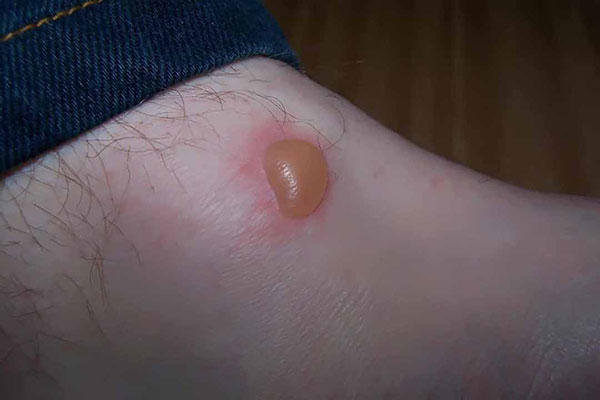 Cách chăm sóc da bị mụn nước