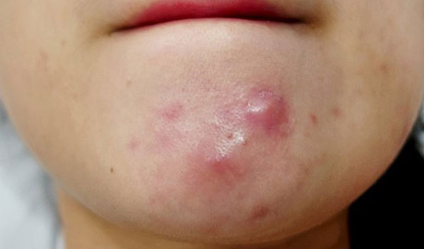 có những loại mụn trứng cá nào?