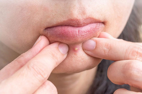 Mụn đầu đinh có nguy hiểm hay không?