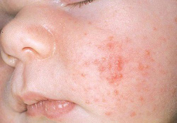 Mụn kê ở trẻ sơ sinh là gì?