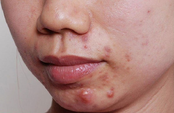 Mụn quanh miệng là bị sao?
