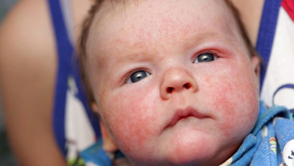 Những lưu ý khi chăm sóc và trị mụn sữa ở trẻ mới đẻ