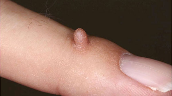 Phân loại mụn cóc