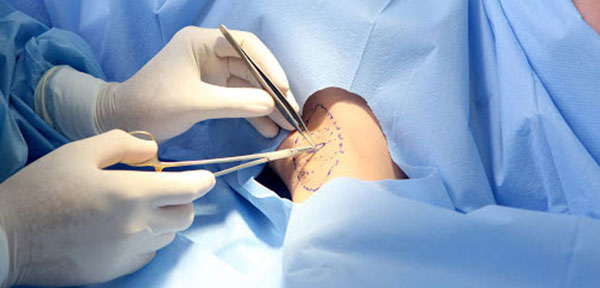 Điều trị hôi nách an toàn tại Hải Phòng