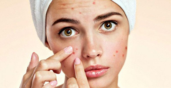 Những việc nên làm sau khi nặn mụn