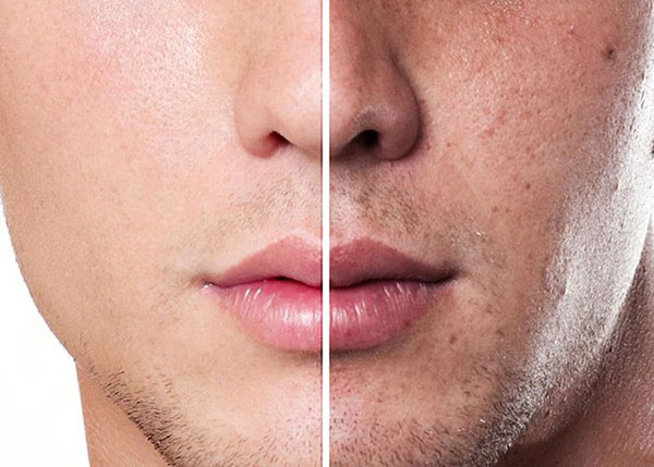 Cách chữa nám da ở đàn ông