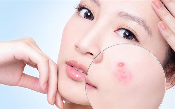 Mụn nhọt bị sưng to và cách chữa trị hiệu quả