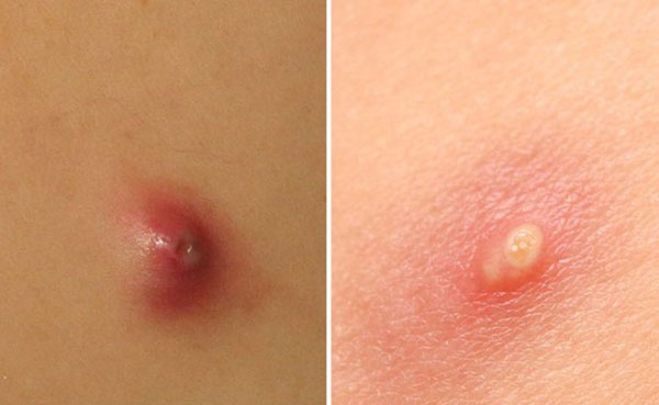 Mụn nhọt bị sưng to và cách điều trị triệt để