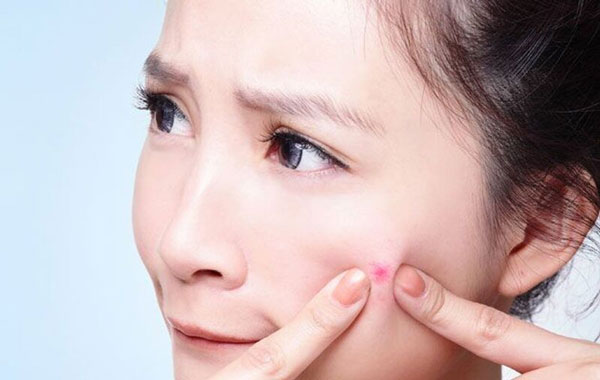 Mụn trứng cá tuổi dậy thì nguyên nhân và cách chữa trị