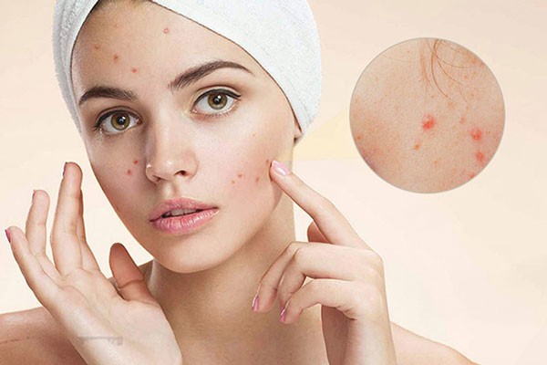 Nguyên nhân và cách điều trị mụn trứng cá ở tuổi dậy thì