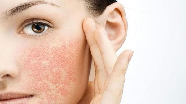 Phương pháp điều trị mụn cho da nhạy cảm