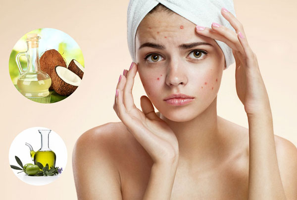 Trị mụn bằng dầu dừa an toàn hiệu quả